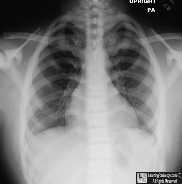 osteopetrosis